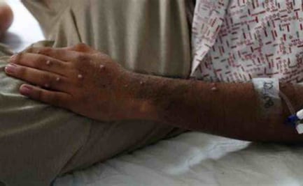 OMS levanta la emergencia sanitaria internacional por mpox; registran descenso de casos