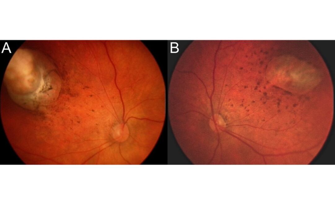 Esta combinación de imágenes muestra anormalidades en el fondo de los ojos de un bebé diagnosticado con microcefalia debida posiblemente a una infección congénita con zika  (Foto: AP)