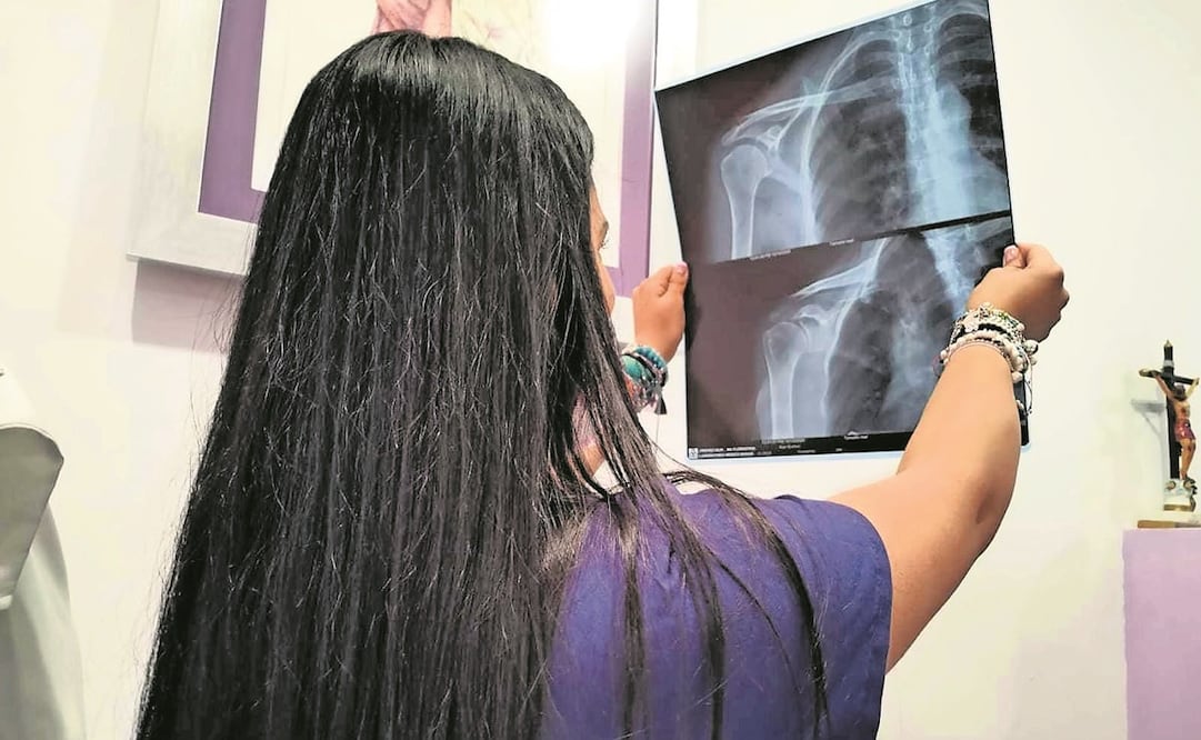 Las secuelas pueden tardar de 4 semanas a 6 meses en curarse. Foto: ARCHIVO EL UNIVERSAL