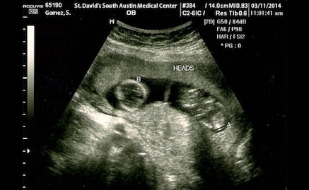 Fetal monitoring device developed by Mexican scientists