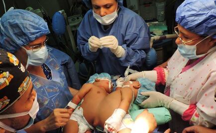 En medio de crisis de salud, separan a siamesas en Venezuela