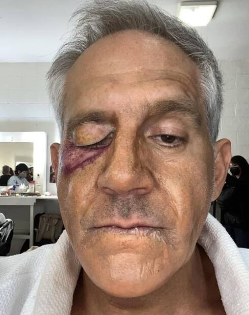 ¡Con el ojo morado! Arath de la Torre queda "igualito" que Alfredo Adame