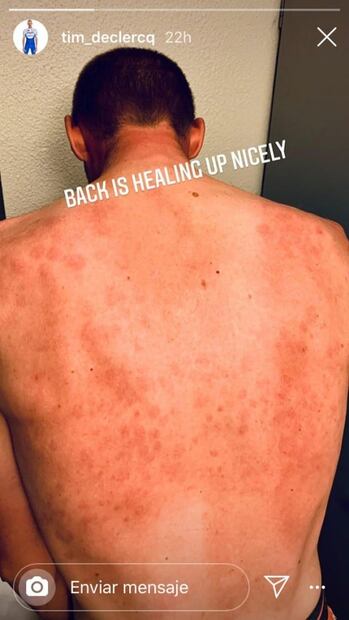 Ciclista muestra como queda su espalda tras rodar en granizada