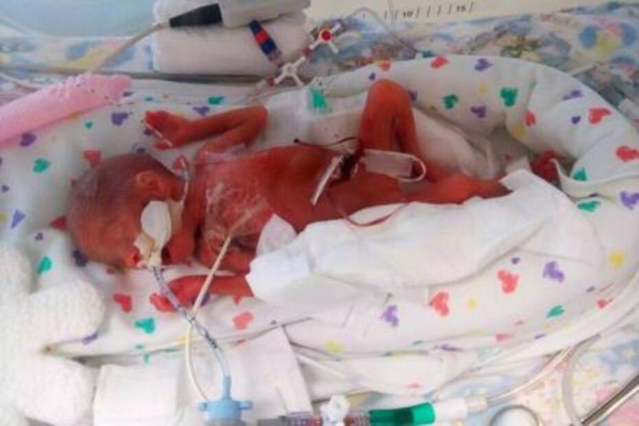 Mujer muestra cómo su bebé prematura nació con la piel roja y casi transparente