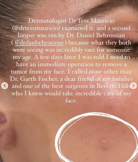 Khloé Kardashian, su diagnóstico de cáncer en la piel: todo lo que sabemos 