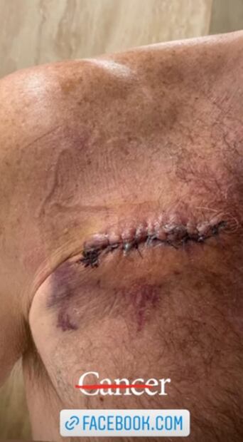 Julián Gil habla de la misteriosa cicatriz en el pecho: cáncer de piel