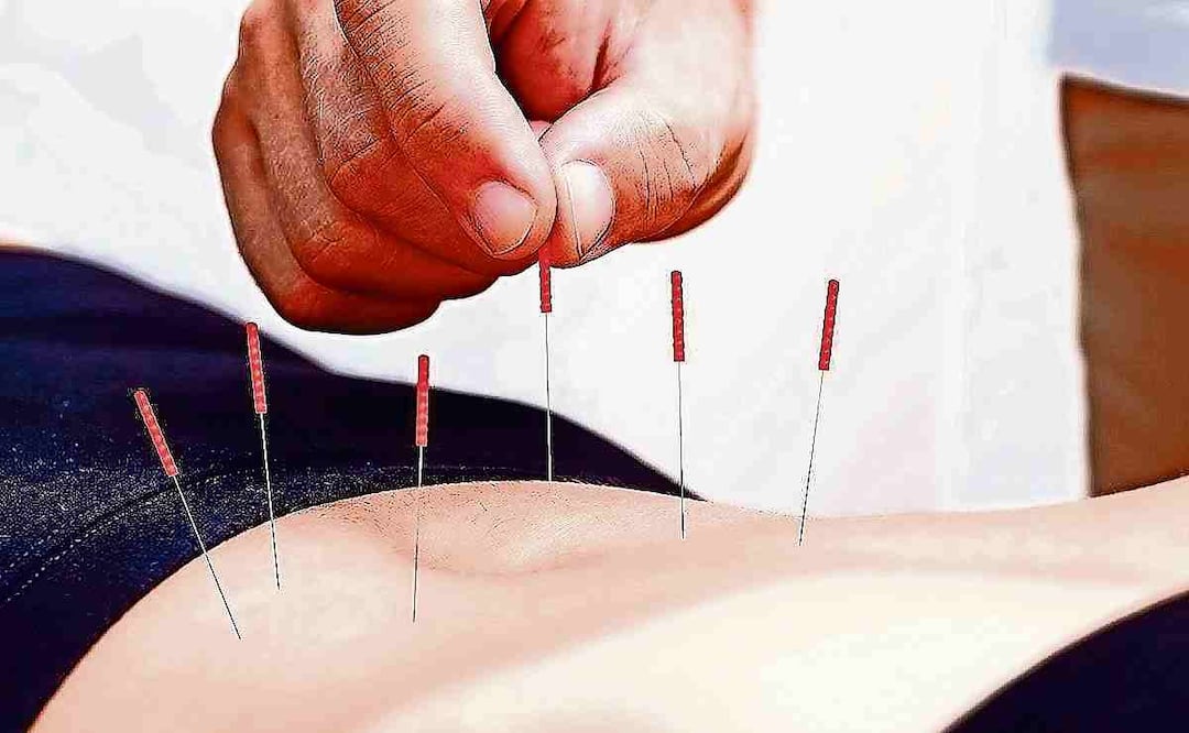 La acupuntura ha demostrado eficacia en dolor dental, náuseas y vómitos postoperatorios. Foto: Archivo EL UNIVERSAL