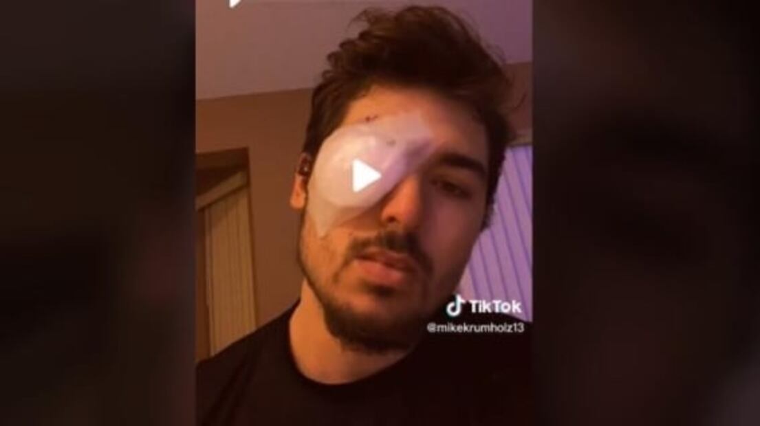"Parásitos se comieron mi ojo": Hombre se queda ciego tras tomar una siesta