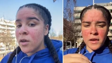 Es alérgica al agua y hasta el sudor le hace daño; aun así, es maestra de natación