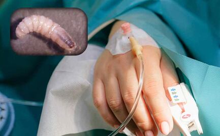 Detectan 21 casos de miasis humana por gusano barrenador en Chiapas; Palenque y Tapachula, los municipios más afectados