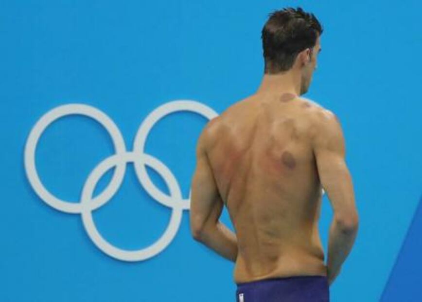 Michael Phelps y los círculos morados en la espalda