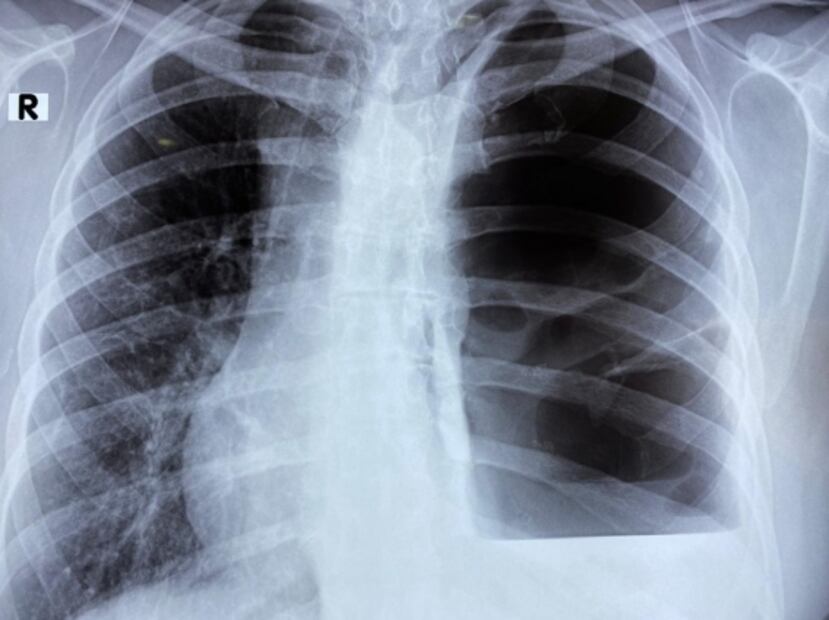 Asintomáticos de Covid-19 pueden tener daños en sus pulmones