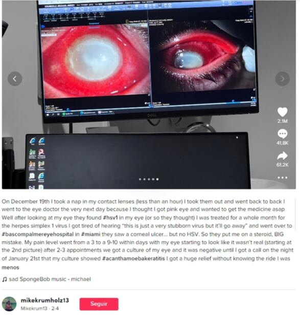 TikTok: Joven olvida quitarse lentes de contacto para tomar siesta y casi pierde un ojo