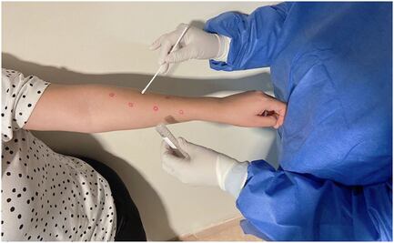 Confirman primer caso de Mpox en Baja California Sur; se trata de un hombre de 26 años 