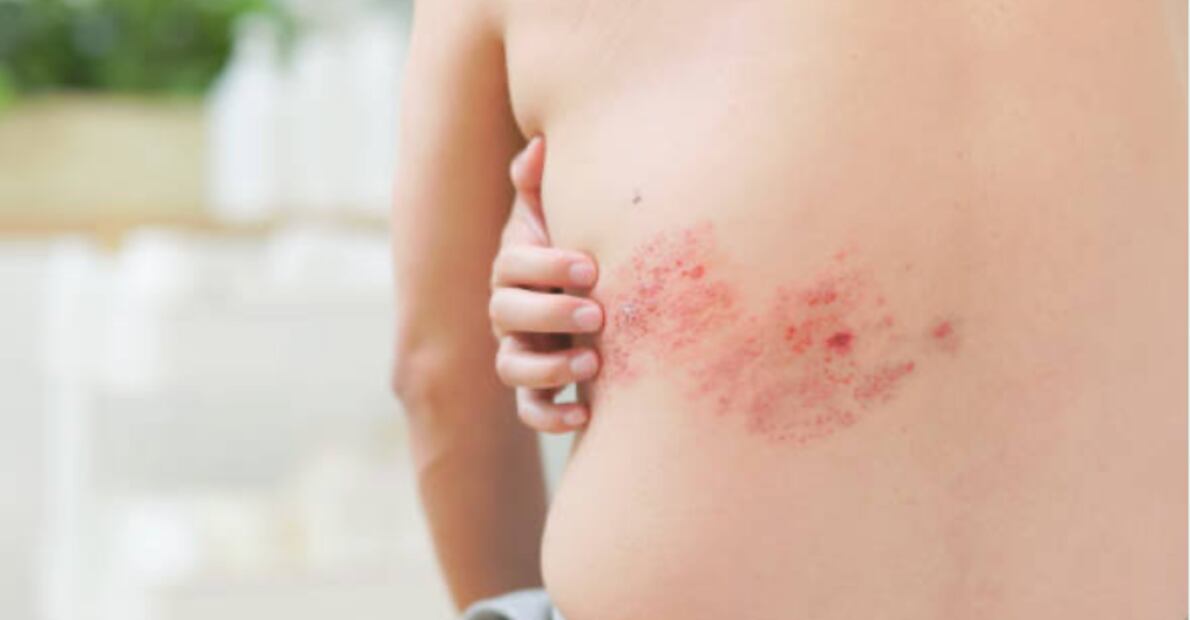 Herpes zóster. Foto: Pixabay