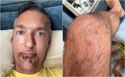 "Las lesiones son brutales"; estrella para adultos narra su infección de viruela del mono