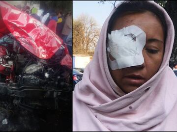 Cinthya está a punto de perder la visión de un ojo, pide justicia por "microbusazo" de Naucalpan