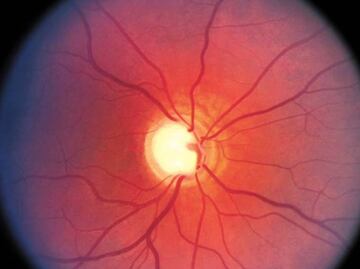 Siete de 10 personas desconocen tener glaucoma