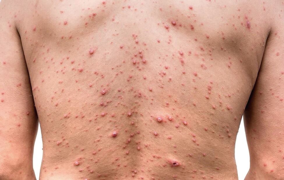 La "viruela de Alaska", un aislado virus de ADN bicatenario proveniente del mismo género que la viruela, la viruela símica y la viruela vacuna, el cual fue detectado por primera vez en 2015.