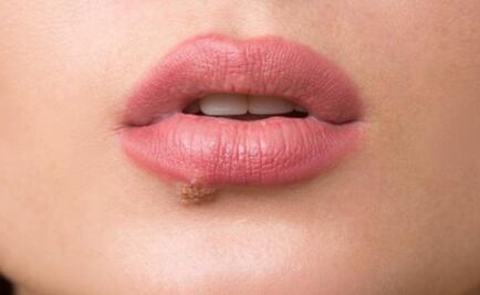 Infecciones respiratorias pueden causar "fuegos labiales"