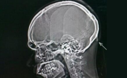 Uso de celulares provocaría crecimiento de “cuerno” en las personas