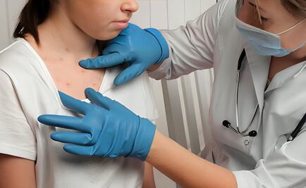 Sarampión en México: Estos son los síntomas de la enfermedad que se ha disparado en el país