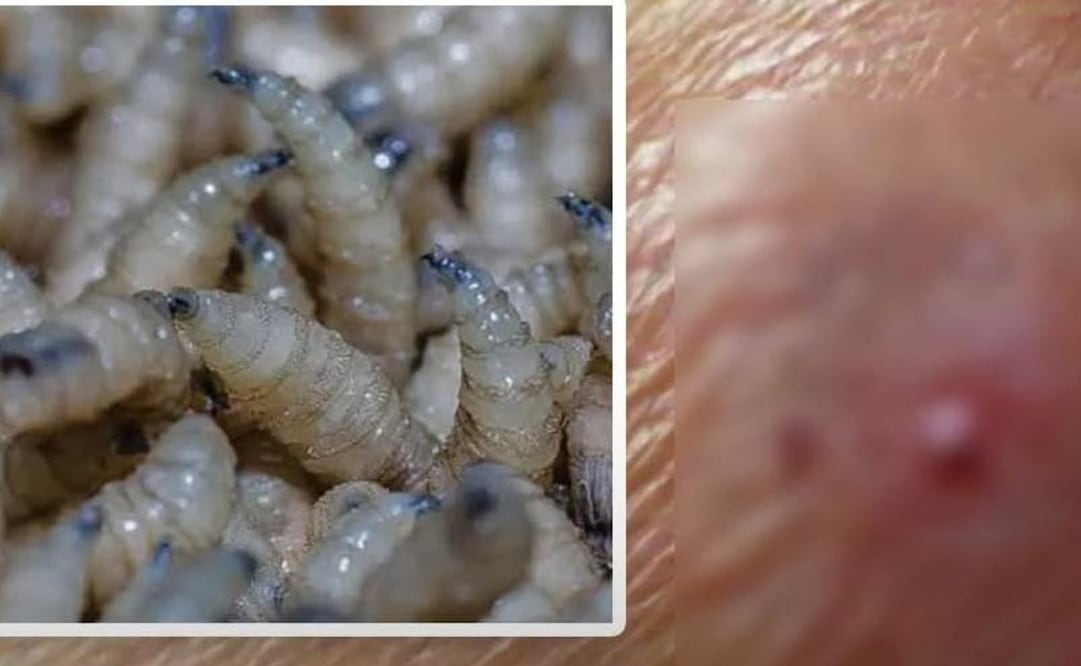 Otro caso de gusano barrenador en humano.
Foto Especial