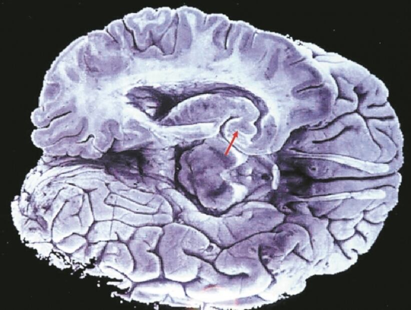 La actividad neuronal durante el sueño podría ayudar a prevenir el Alzheimer