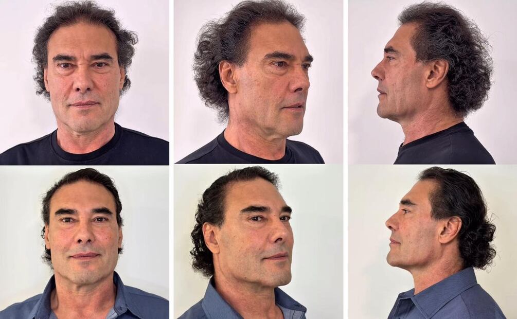 El resultado del tratamiento de rejuvenecimiento facial es natural. Foto: Instagram @eduardoyanezofc @dr.gabush_