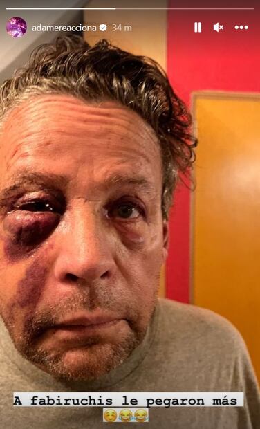 Alfredo Adame muestra su rostro tras cirugía: "A Fabiruchis le pegaron más"