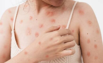 Mpox: ¿qué es, cómo se contagia y cuál es el tratamiento para la viruela del mono?