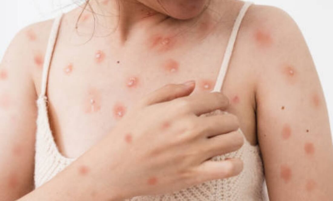 La viruela símica, es considerada una enfermedad infecciosa, generada por un virus que provoca erupciones dolorosas Foto: Istock