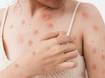 Brote mpox: ¿Cómo prevenir la viruela del mono?