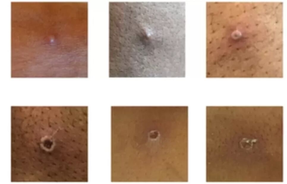 Viruela del mono. Expertos explican por qué no será una pandemia como la del Covid-19 