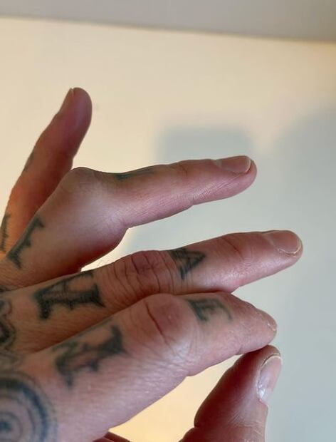 Blink-182: Travis Barker sube impactante fotografía de la operación en su dedo tras cancelación de gira 