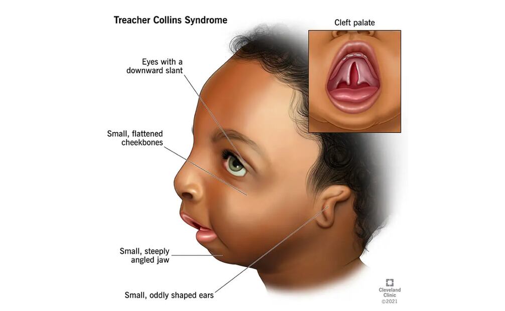 El síndrome es causado por mutaciones en uno de tres genes: TCOF1, POLR1C o POLR1D.
Foto: Medline Plus
