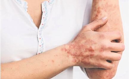 Reino Unido cerca de agotar existencias de vacuna contra la viruela del mono