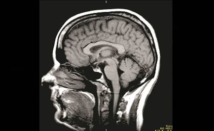 Mujeres con depresión, más propensas a sufrir Alzheimer