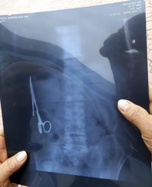 Retiran tijeras que llevaban 18 años en el estómago de un hombre