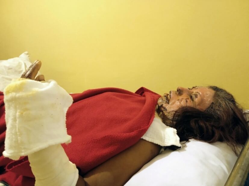 Olivia, mujer quemada con aceite, quiere que su agresor vea su rostro y que se cuente su historia