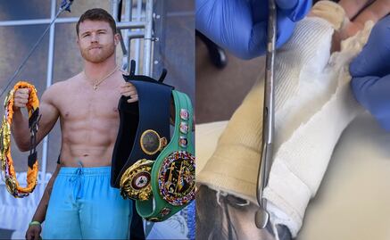 Así quedó la mano del Canelo Álvarez tras cirugía que lo alejaría del boxeo
