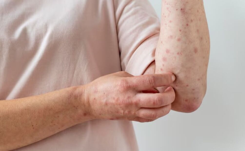 En lo que va de año, el CDC documenta 14 brotes (con 3 o más casos relacionados), con el 93% de los casos confirmados asociados a estas infecciones grupales. Fuente: Freepik