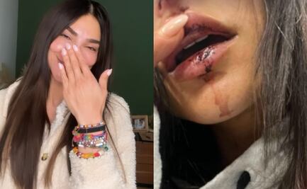Tras aparecer con una parte del rostro ensangrentado, la conductora Alejandra Espinoza habla de su accidente