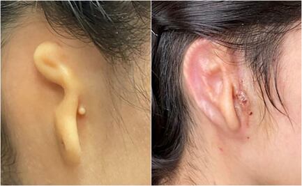 Implantan en EU oreja humana creada a partir de células de paciente