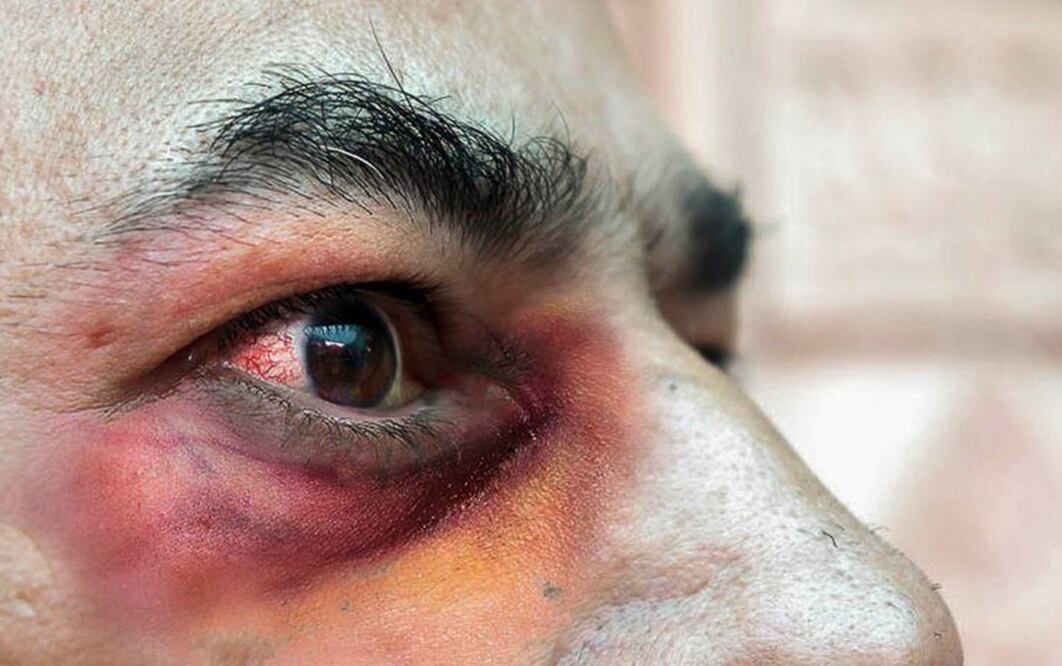 Hongo negro en México. Foto: UNAM DGCS 