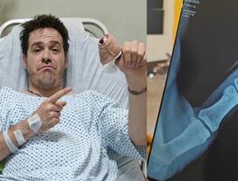 Tiktoker sufre accidente al poner a prueba herramienta de jardinería; “la tijera cortó mi hueso, lo partió en dos”