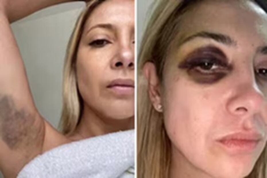 Las fotos difundidas de Fabiola Yáñez con signos de violencia. Foto: La Nación. GDA