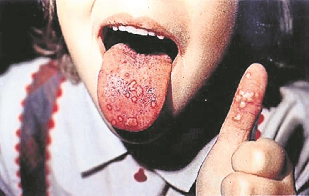 ​Alerta por coxsackie, lo más compartido