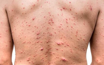 Edomex confirma 5 casos de viruela del mono