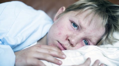 "Amnesia inmunológica", cuando el sarampión resetea la memoria de las enfermedades que padeciste